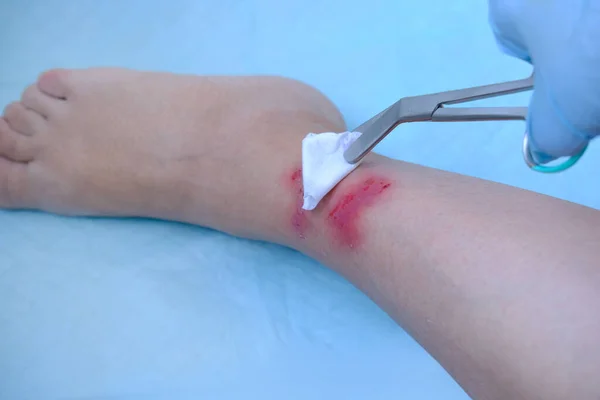 close-up of human shin, doctor treats numerous wounds on leg of adult female patient, redness, scarring, sores from scratching, concept of medical care, self-harm to skin, human tissue regeneration