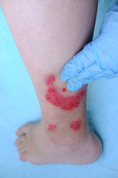 Close Human Shin Doctor Treats Numerous Wounds Leg Adult Female — Fotografia de Stock