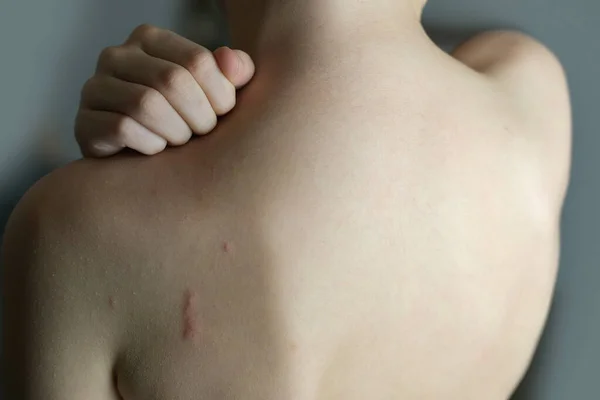 Naked Back Boy Child Years Old Red Papules Skin Blisters — Stock Fotó