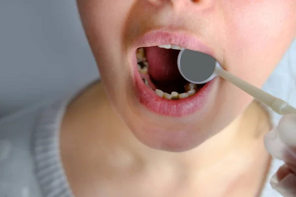 Dentista Médico Examina Cavidad Oral Paciente Femenina Utiliza Espejo Bucal —  Fotos de Stock
