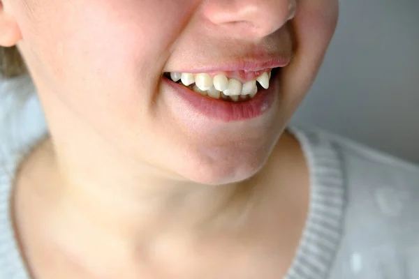 Close Dentes Curvos Mulher Jovem Antes Instalar Aparelho Menina Com — Fotografia de Stock