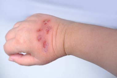 Kadın elini kapat. Dermatoloji kavramı, cildinde çatlaklar ve yaralar olan insan eli, cilt tedavisi, kızarıklık, deri yaralanması, tıbbi bakım, sağlık, insan dokusu yenilenmesi.