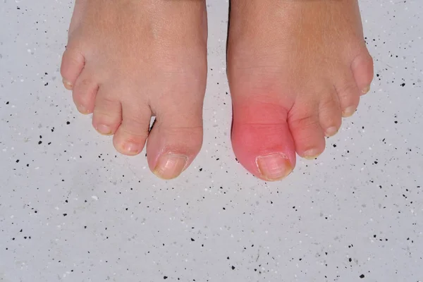 Nahaufnahme Weiblicher Füße Zeh Des Linken Nackten Fußes Entzündet Und — Stockfoto