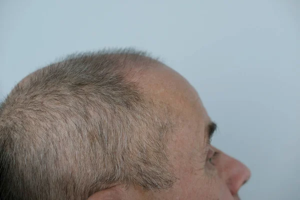 Nahaufnahme Trichologe Behandelt Patienten Glatzköpfige Reife Mann Mit Alopezie Haarwuchsklinik — Stockfoto