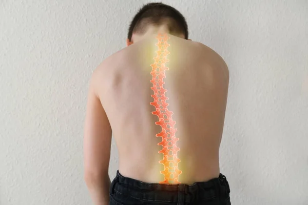 part of naked back of boy, child 8-10 years old is standing, hunched over from back pain, concept of therapeutic massage for osteochondrosis, scoliosis, back pain, intervertebral hernia