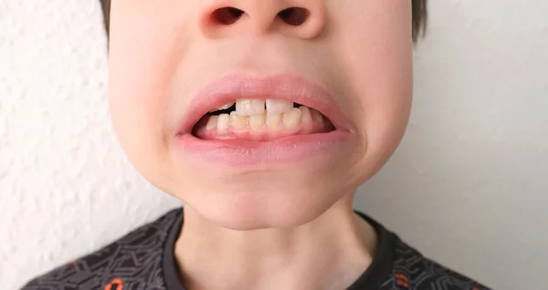 Criança Criança Apresenta Dente Que Balança Dói Conceito Odontologia Pediátrica — Fotografia de Stock