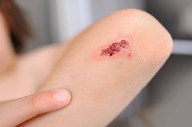Çocuğun elindeki iyileşme yarası, dirsek bölgesindeki kabuk aşınması, yara izi, çocuklar için travmatik güvenlik kavramı, yaralanmaların tedavisi, sağlık riski, aşınmanın bakteriyel kirlenmesi.