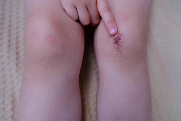 healing wound on leg of child, crusted abrasion in knee area, scar, traumatic safety concept for children, treatment of injuries, medical care, health risk, bacterial contamination of the abrasion