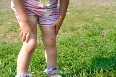Taze yara, kız çocuğunun dizlerinde kanama, yürüyüş sırasında düşme, çocuklar için travmatik güvenlik konsepti, yaralanmaların tedavisi, tıbbi bakım, çocukların hiperaktivitesi, bakteriyel kirlilik