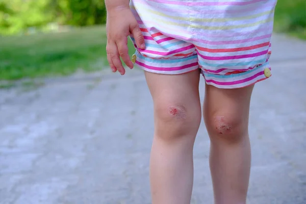 fresh wound, bleeding abrasion on knees of girl child fell on walk, traumatic safety concept for children, treatment of injuries, medical care, hyperactivity of children, bacterial contamination