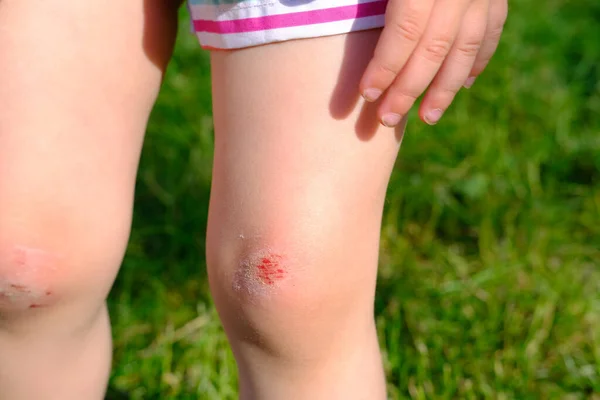 fresh wound, bleeding abrasion on knees of girl child fell on walk, traumatic safety concept for children, treatment of injuries, medical care, hyperactivity of children, bacterial contamination