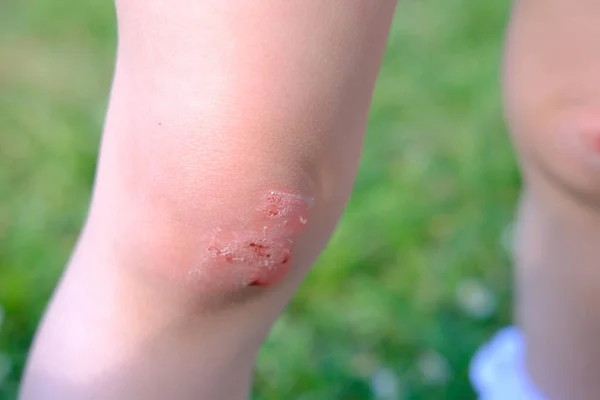 fresh wound, bleeding abrasion on knees of girl child fell on walk, traumatic safety concept for children, treatment of injuries, medical care, hyperactivity of children, bacterial contamination