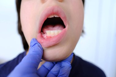 dentist, doctor examines oral cavity of small patient, closeup part of boy of 10 years old, concept pediatric dentistry, dental treatment, correction of occlusion, oral care, caries prevention