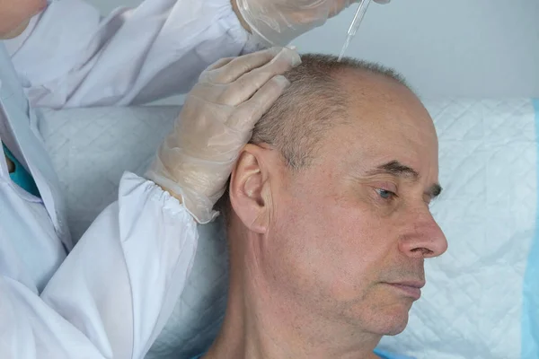 Närbild Trichologist Behandlar Patienten Skallig Mogen Man Med Alopeci Hårväxt — Stockfoto