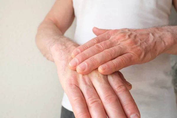 Close up of male hands with dry skin damage, applying moisturizer. Dermatology concept human hands with skin with cracks and wounds, skin treatment, aging hand skin care