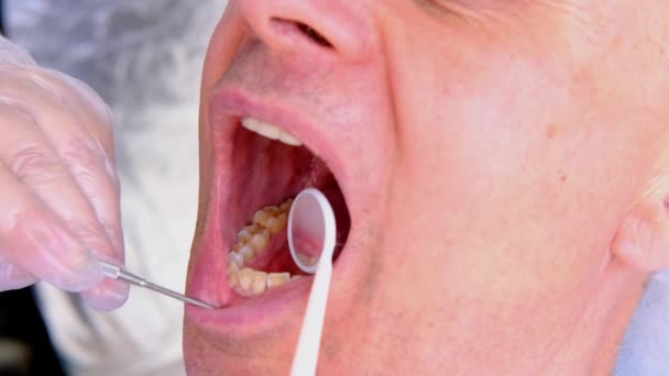 치과의 의사는 벌리고 보철에 검사를 가지고 환자의 구강을 검사한다 — 비디오