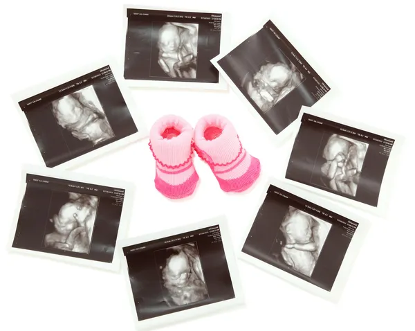 Grupo de imágenes 3D de ultrasonido 4D alrededor de un par de botas de bebé rosadas — Foto de Stock