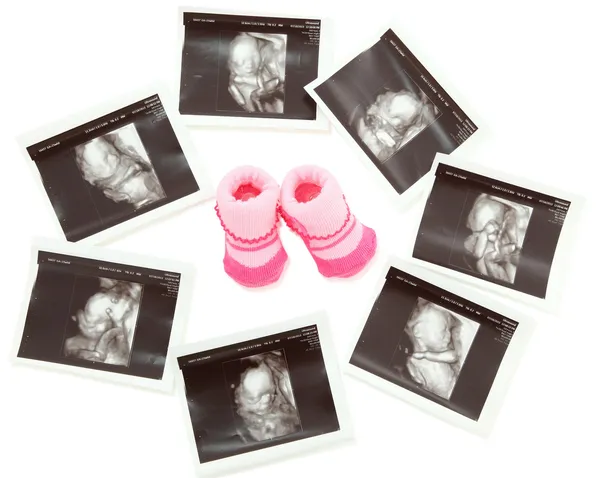 Group of 3D 4D Ultrasound images around a pair of pink baby boot — Stock Photo, Image