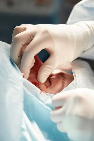 Close up da face de um paciente que está sendo submetido a blefaroplastia. O cirurgião corta a pálpebra e realiza manipulações usando instrumentos médicos — Fotografia de Stock