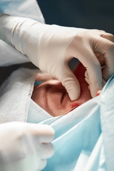 Egy blepharoplasztikai műtéten átesett beteg arcának közeli képe. A sebész felvágja a szemhéját, és orvosi eszközökkel manipulál. — Stock Fotó