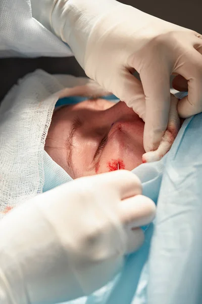 Kan pıhtılaşması geçiren bir hastanın yüzünü kapatın. Cerrah göz kapağını keser ve tıbbi aletlerle manipülasyon yapar. — Stok fotoğraf
