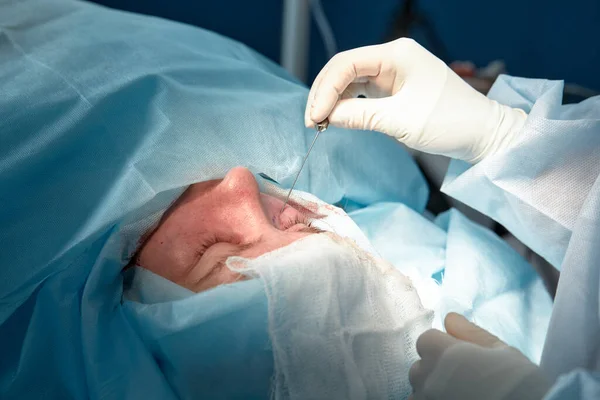 Закрыть лицо пациента, который проходит блефаропластику. Хирург режет веко и выполняет манипуляции с помощью медицинских инструментов — стоковое фото