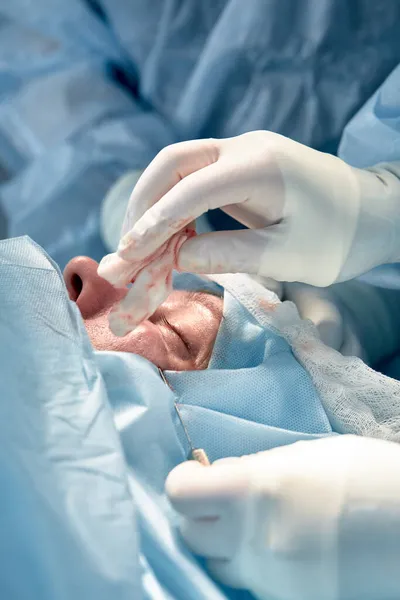 Закрыть лицо пациента, который проходит блефаропластику. Хирург режет веко и выполняет манипуляции с помощью медицинских инструментов — стоковое фото
