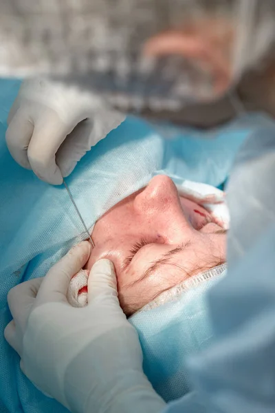 Close up da face de um paciente que está sendo submetido a blefaroplastia. O cirurgião corta a pálpebra e realiza manipulações usando instrumentos médicos — Fotografia de Stock