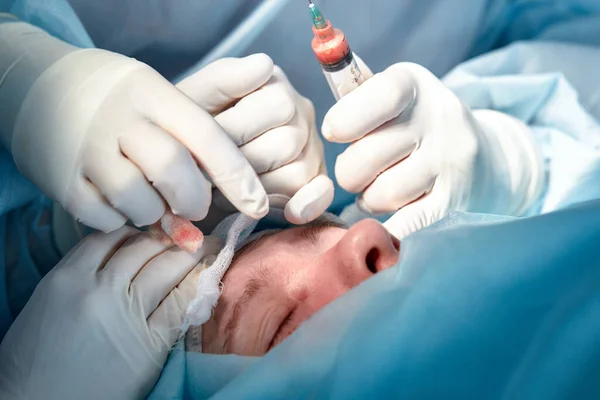 Egy blepharoplasztikai műtéten átesett beteg arcának közeli képe. A sebész felvágja a szemhéját, és orvosi eszközökkel manipulál. — Stock Fotó