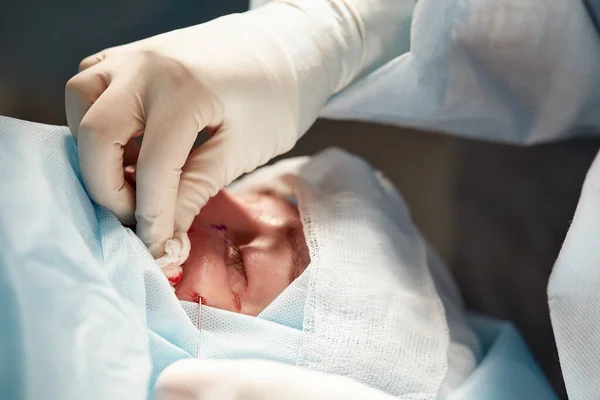 Gros plan du visage d'un patient qui subit une blépharoplastie. Le chirurgien coupe la paupière et effectue des manipulations à l'aide d'instruments médicaux — Photo