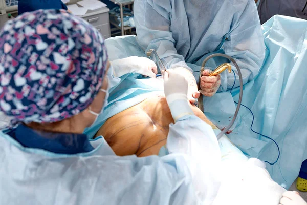 Chirurg s asistentkou operuje na ženském prsu, mammoplastice, prsní onkologii. — Stock fotografie