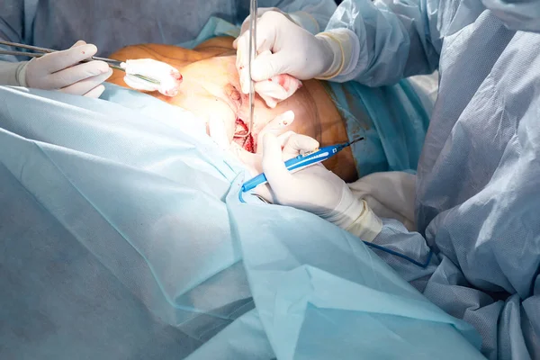 Um cirurgião com um assistente opera na mama feminina, mamoplastia, oncologia da mama. — Fotografia de Stock
