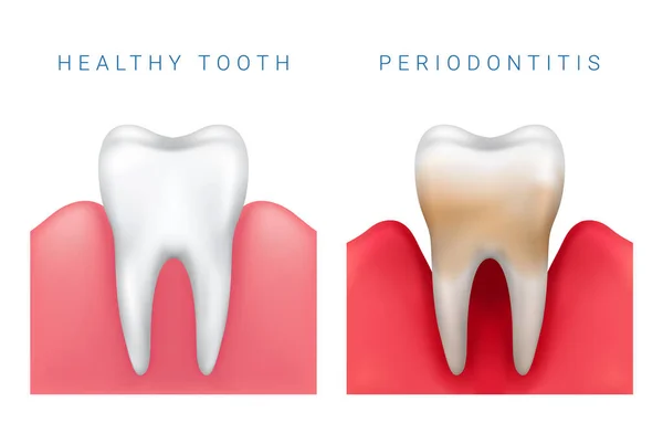 Gerçekçi sağlıklı diş ve periodontit hastalığının vektör tıbbi çizimi