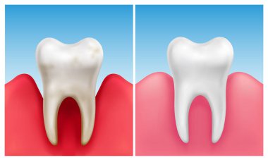 Diş eti hastalığının vektör çizimi - sağlıklı beyaz dişle karşılaştırıldığında periodontit