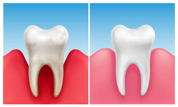 Ilustração Vetorial Doença Gengival Periodontite Comparação Com Dente Branco Saudável —  Vetores de Stock