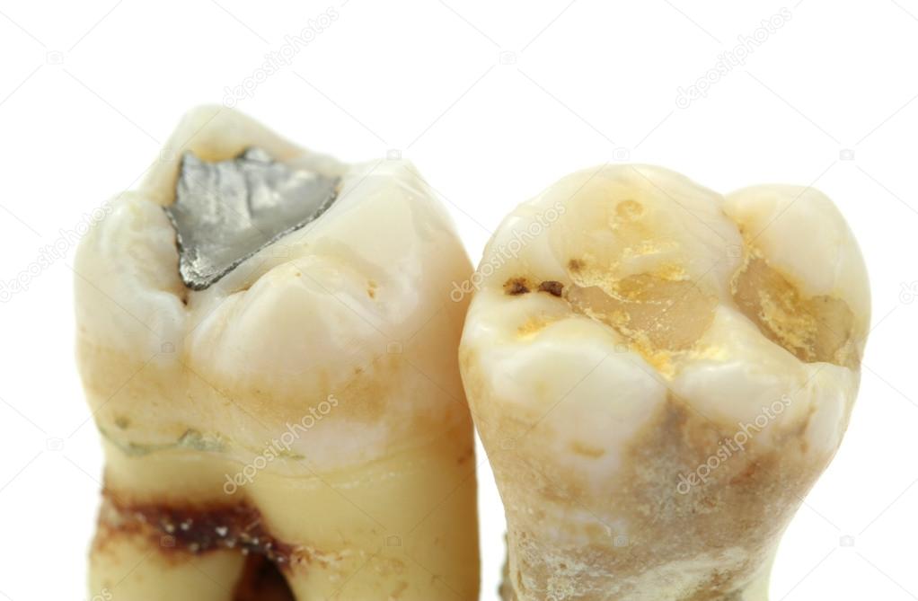 Extracted teeth with details of caries,