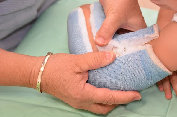 Cast removal — Stock Photo, Image