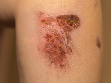 A wound on the body. Skin regeneration. Limb injury. Scratched knee.