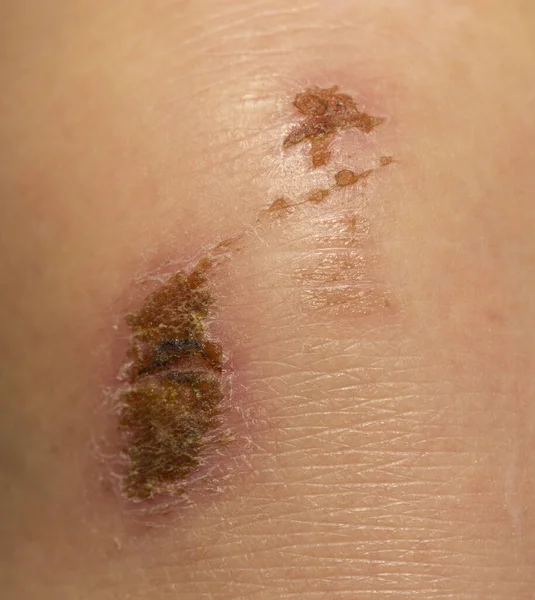 Wound Body Skin Regeneration Limb Injury Scratched Knee — Foto de Stock