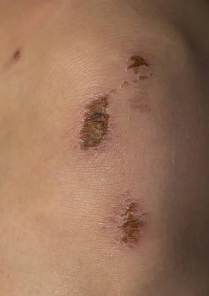 Wound Body Skin Regeneration Limb Injury Scratched Knee — Stockfoto