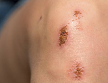 A wound on the body. Skin regeneration. Limb injury. Scratched knee.