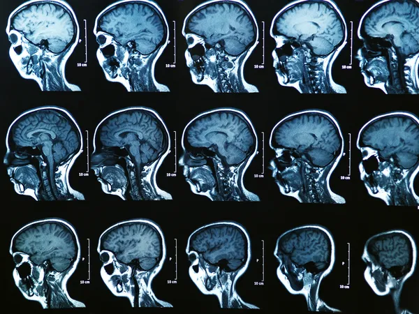 МРТ-сканирование мозга — стоковое фото