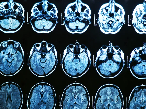 Resonancia magnética cerebral — Foto de Stock