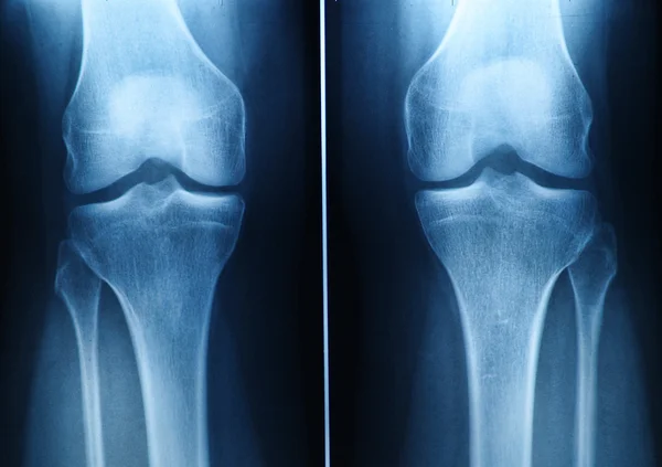 Knie x-ray — Stockfoto