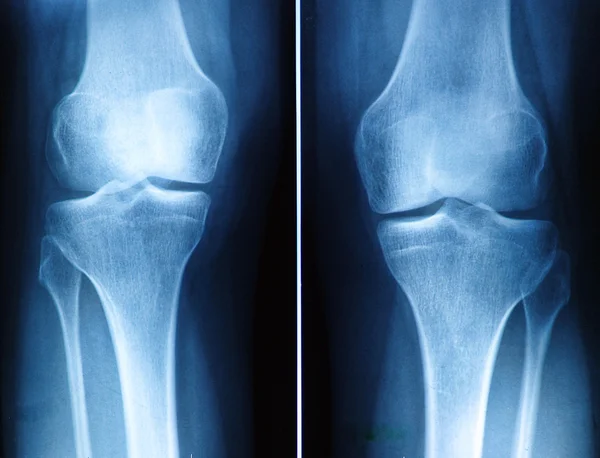 Ακτινογραφία γόνατος — Φωτογραφία Αρχείου