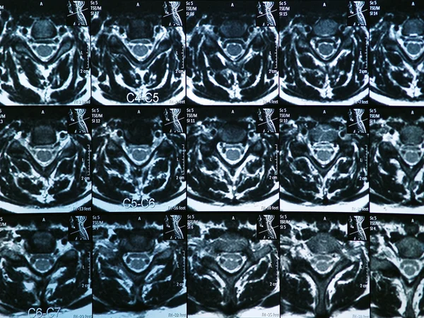 MRI C-позвоночник — стоковое фото