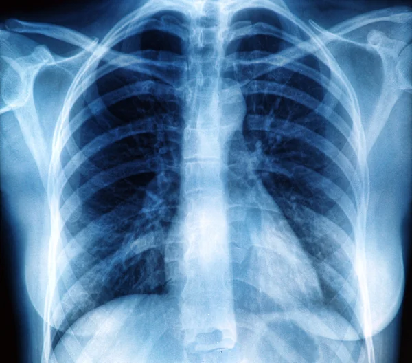 Röntgenbild der Brust Stockfoto