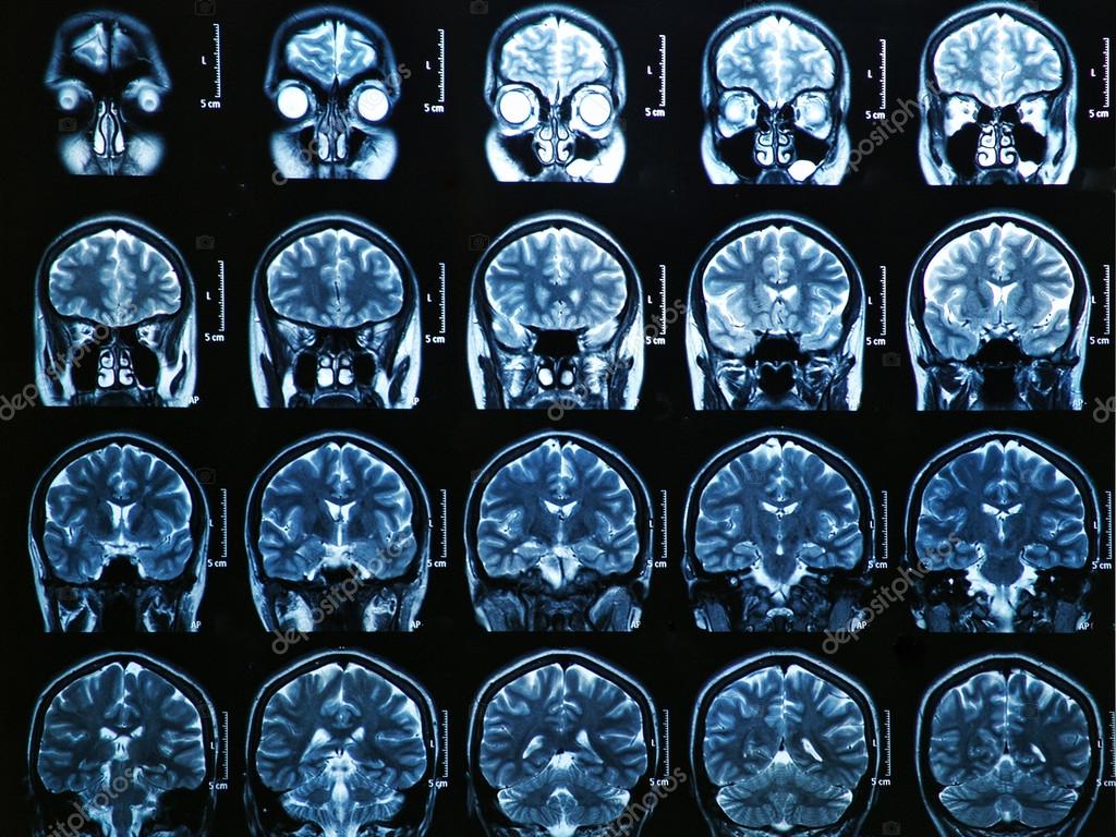 Mri Brain Scan Stock Photo By C Bunyos30