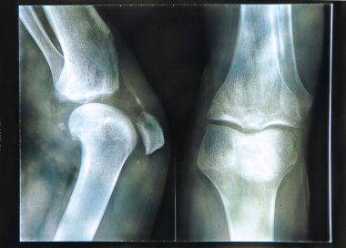 Knee X-ray clipart