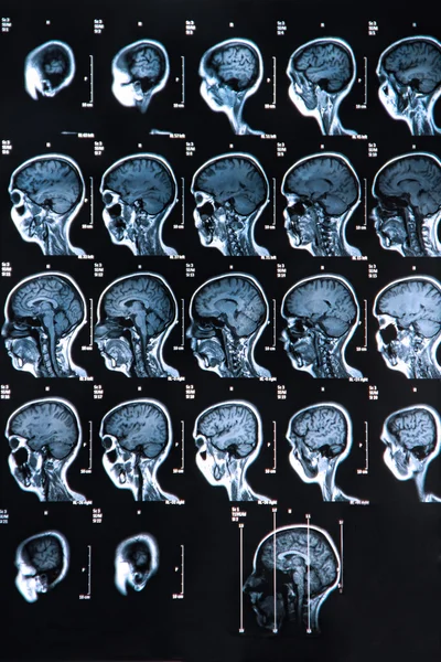 MRI Brain Scan — Stock Photo, Image